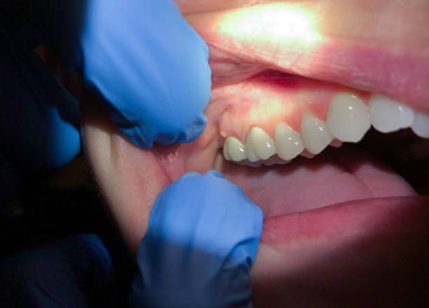 Best Cracked Tooth Emergency Dentist  in Citronelle, AL